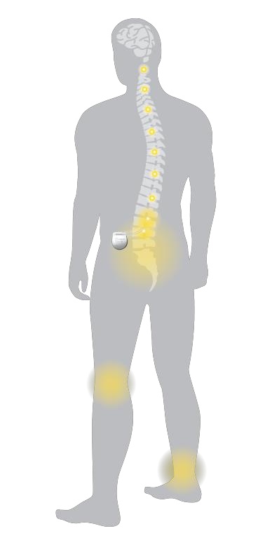 SCS Impulsgeber & Stimulation
